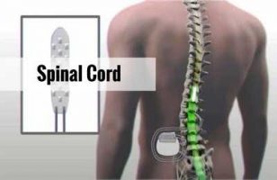 Single radiation sufficiently relieves spinal cord compression symptoms, finds Study