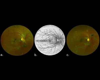 Unique retinal scar visible in Ebola Survivors