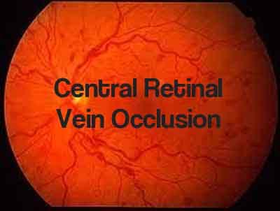 Avastin as effective as Eylea for treating central retinal vein occlusion