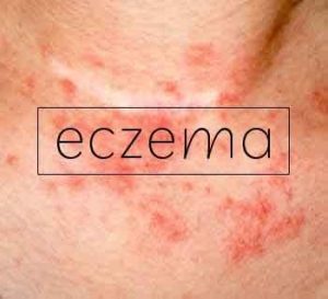 No clinical benefit of Bath additives in child eczema : BMJ