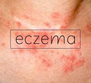 Eczema drug effective against severe asthma