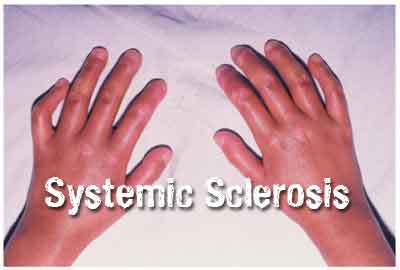 Lenabasum is new treatment for diffuse cutaneous systemic sclerosis (dcSSc)