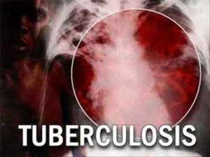 Relapse-free cure from MDR-TB higher than anticipated