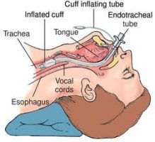 et intubation