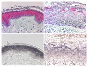 EDF Management Guidelines for Anogenital Warts