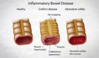 Use of (DPP-4) inhibitors linked to increased risk of IBD : BMJ