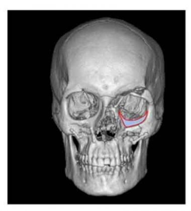 KGMU Conducts First Computer based Eye Socket Reconstruction KGMU Conducts First Computer based Eye Socket Reconstruction