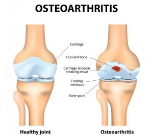 Knee crepitus linked with symptomatic osteoarthritis