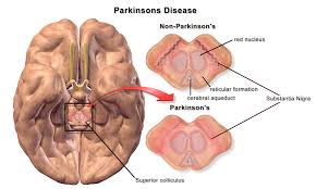 Robotic device improves balance and gait in Parkinsons disease patients