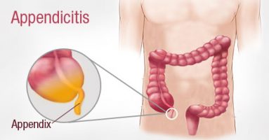 Ruptured Abdominal Aortic Aneurysm Misdiagnosed as Acute Appendicitis