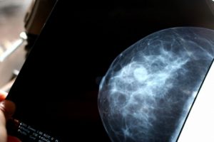New Breast Imaging System for better Diagnosis of Tumor Subtypes