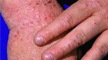 Study analyses link between eczema, cardiovascular disease: British Journal of Dermatology