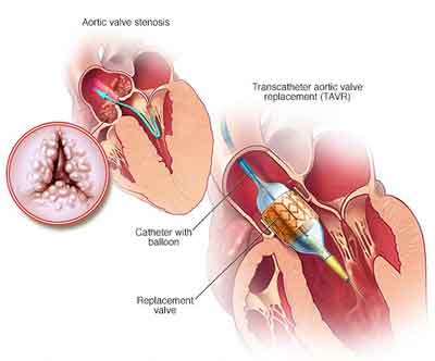 New TAVR System Safe and Effective for High-Risk Surgical Patients with Severe Aortic Stenosis