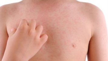 No role of steroids in management of isolated acute urticaria, finds trial