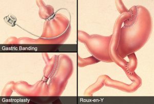 4 fold reduction in Diabetic microvascular complications after Bariatric surgery