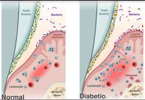 Diabetes causes shift in oral microbiome that fosters periodontitis, Penn study finds