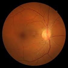 Potential biomarkers for early diagnosis of macular degeneration identified