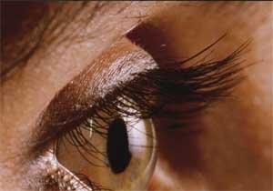 Laser Treatment Appears to Reduce Eye Floater Symptoms: JAMA Ophthalmology