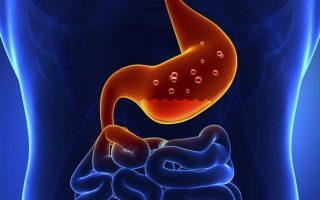 Treatment of severe hyperacidity prevents cancer oesophagus