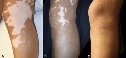 Melanocyte-keratinocyte transplantation procedure-long-term benefits for restoring skin pigmentation