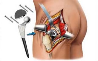 Hip replacement surgery improves quality of life and also life expectancy