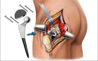 Case study: Hips replacment of patient with cardiomyopathy