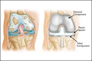 Hip and Knee Replacement Patients Using Fewer Opioids to Manage Pain After Surgery