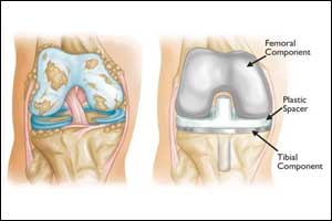 Injections of anaesthetic agents recommended during knee replacement  for Post Operative pain relief