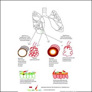 COPD: Changes in the lungs, changes in the microbiome