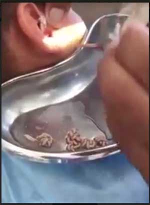 Doctor removes dozens of squirming live maggots from a boys ear, Check out the Video