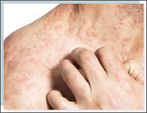 EADV Updated guideline for treatment of atopic eczema