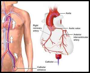 Coronary artery disease in patients undergoing coronary angiography