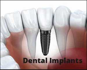 Oral implants -- The paradigm shift in restorative dentistry