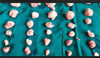 Doctors remove 50 tumours from uterus of Indian woman