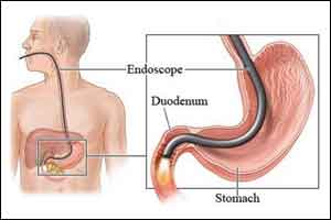 Promising results of endoscopic treatment of Gastoparesis