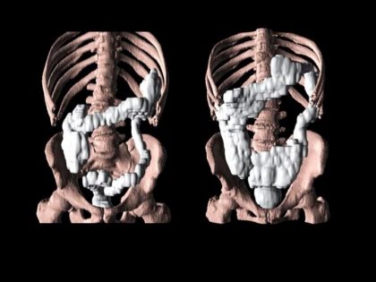 Gastrointestinal dysfunction in Parkinson’s patients : two new studies offer insights into Gastrointestinal dysfunction in Parkinson’s patients : two new studies offer insights into