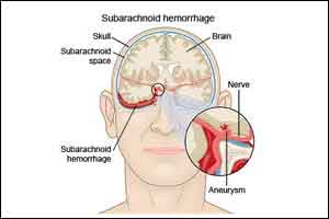 Expert care critical in management of Subarachanoid haemorrhage