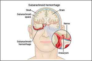 Incidence of Spontaneous subarachnoid hemorrhage rising in pregnant women