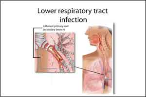 Even Brief air pollution exposure tied to LRTI