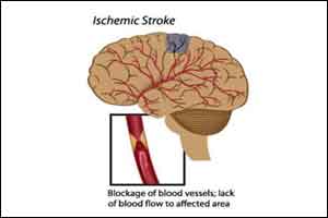 A new safer drug found for ischemic Stroke