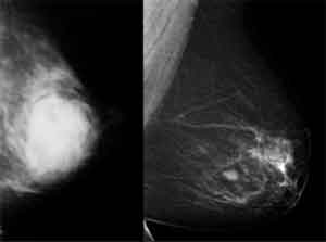 Mammography useful in males also- may help predict cancer in high risk population