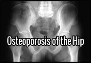 Apollo Hospital study looks at Transient osteoporosis of the hip