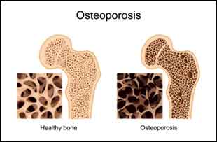 Guideline Updates for managing Low Bone Density and Osteoporosis