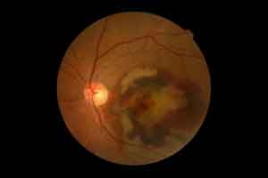 New Retina scanner detects diseases before vision loss occurs