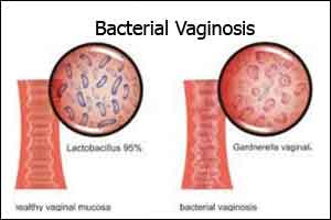 CDCs STD Treatment Guidelines -Bacterial Vaginosis