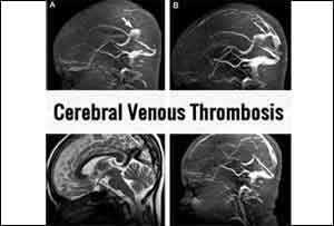 New Guidelines on Cerebral Venous Thrombosis released