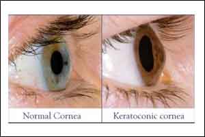 Oral corticosteroid supplementation improves clinical outcomes of isolated corneal bee sting injury