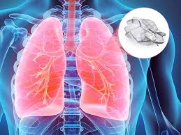 Minimally invasive procedure that improves lung function in patients of severe emphysema