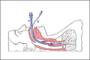 Commercial fastener better than tape for securing endotracheal tube