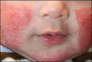 Strange case of  dimorphic skin rash in  patient of cirrhosis : BMJ Case Report